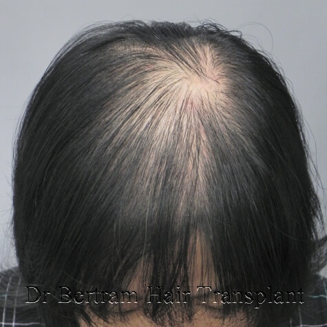 female pattern of hair loss