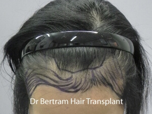 female hair transplant
