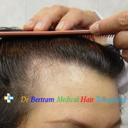 female pattern hair loss