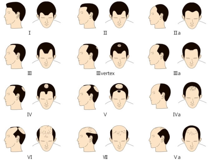 hair loss male pattern