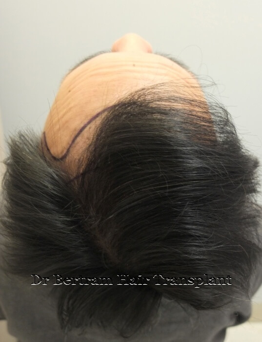hair transplant before and after photo