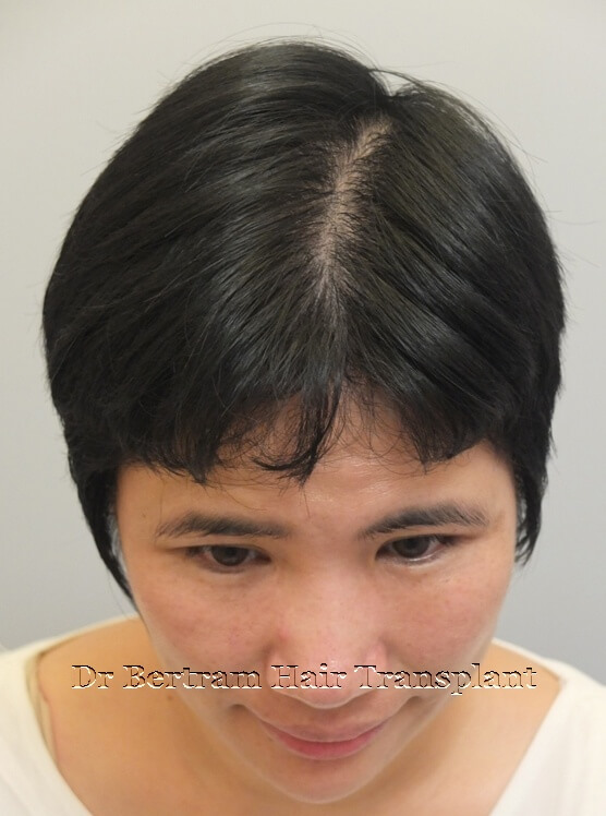 hair transplant before and after pictures