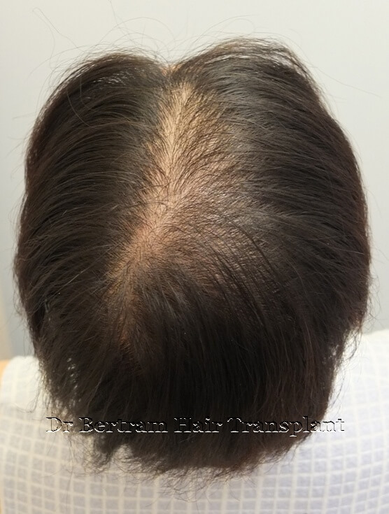 hair transplant before and after pictures