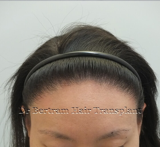 hair transplant before and after picture