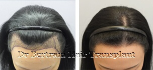 hair transplant before and after picture women