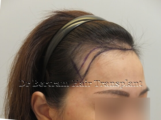 hair transplant before and after picture