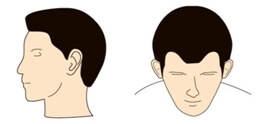 hair loss for male