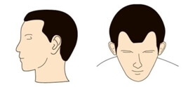 hair loss in male