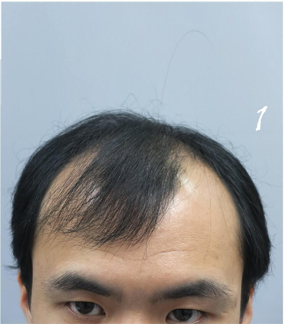 Front and Hairline