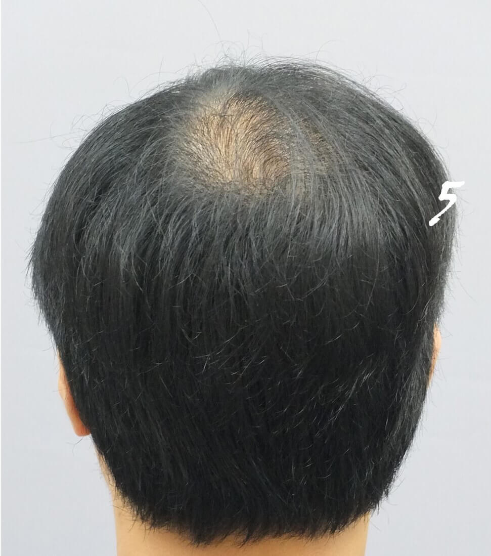 Side of Head (Donor Zone)