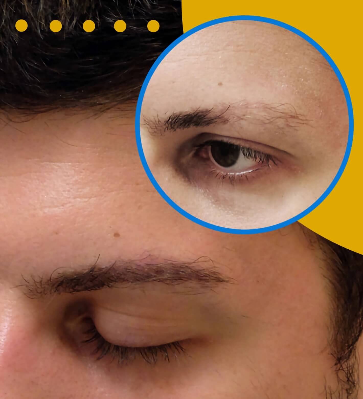 Eyebrow restoration