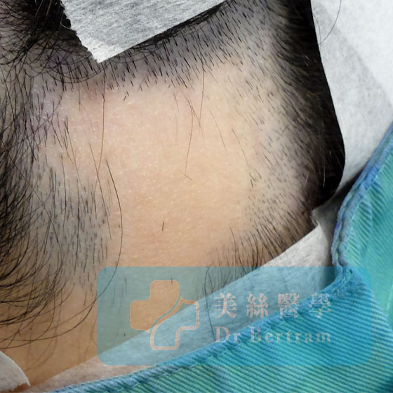 用於斑禿的SMP