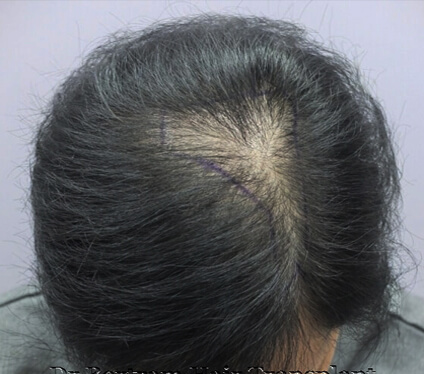 Diffuse thinning