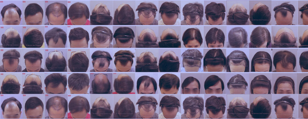女性植髮修復效果臨床圖庫