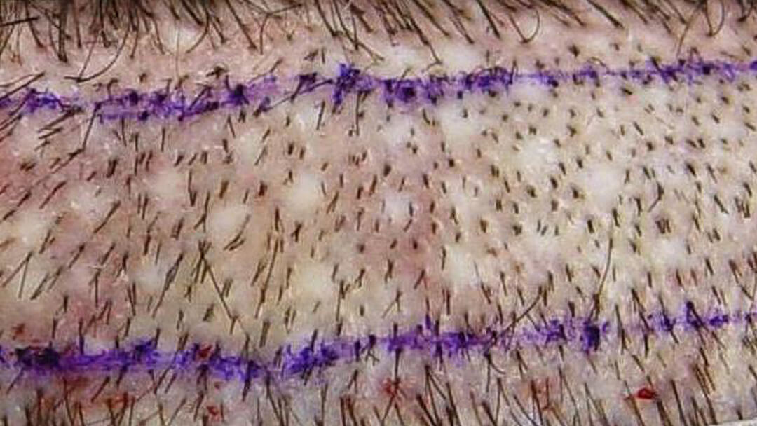 Irreversible thinning in the donor area