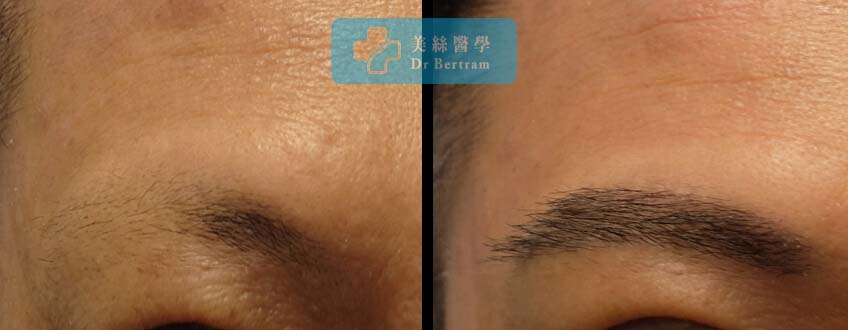 臨床個案：男性眉毛修復