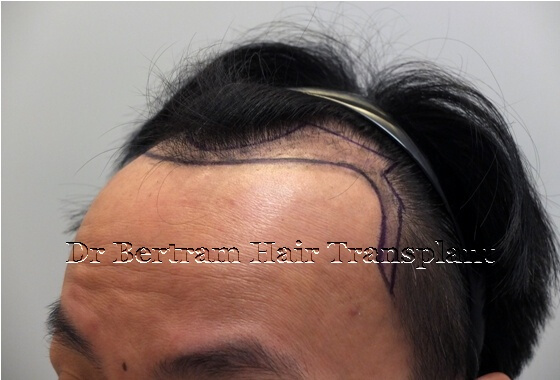 術前：右側角度