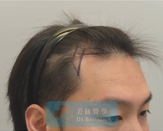 術前：頭頂中部可見稀疏