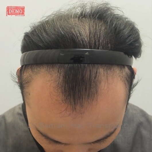 術前：側面角度，顳部後移