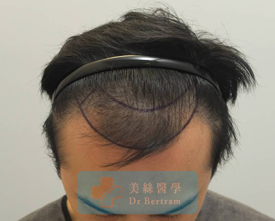 術前：左側可見後移