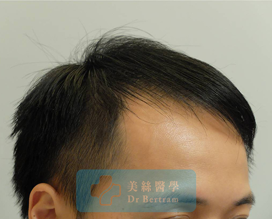 術後12個月：髮際線恢復