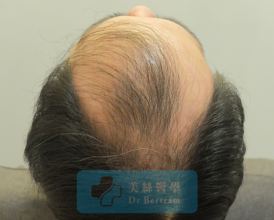 術前：頭頂中部可見稀疏