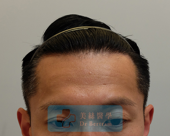 術後12個月：髮際線恢復