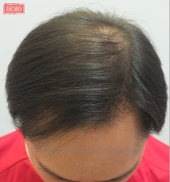 術後達到的密度