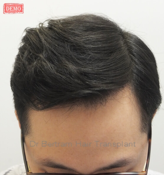 術後12個月：正面角度