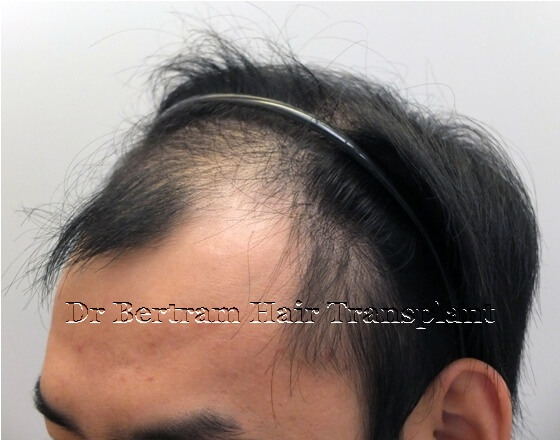術前：右側角度