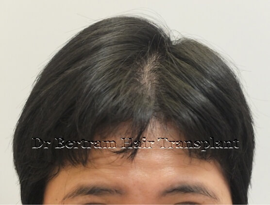 個案1 女性術後12個月：側面角度顯示頭皮可見度降低