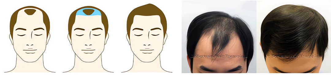 Norwood Class III hair loss