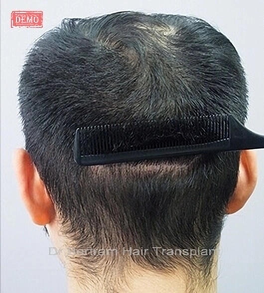 FUT linear scar